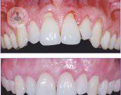 Nueva técnica de cirugía periodontal: menos complicaciones y más resultados