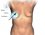 Reconstrucción mamaria después de un cáncer de mama