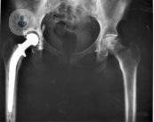 radiografia-protesis-de-cadera