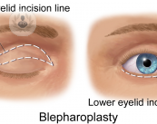 La blefaroplastia, una intervención para recuperar la juventud en la mirada