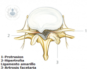 Causas y cirugía del dolor lumbar y de la ciática