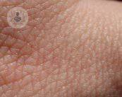 ¿Cómo se detecta el cáncer de piel?