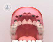 Implantes dentales: consejos y contraindicaciones
