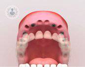 implantologia-dental