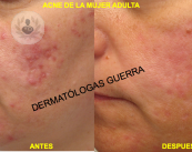 acne-mujer