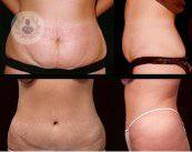 casos-abdominoplastia