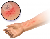 Dermatitis de contacto y alérgica