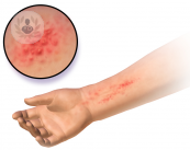 dermatitis-alergica-y-contacto