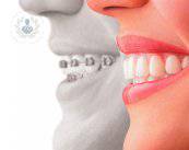 invisalign