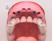 imagen-implantes-dentales