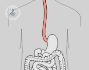 esofago-reflujo-gastroesofagico