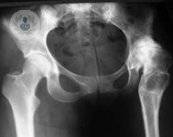 protesis-cadera-joven