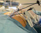 hernia-inguinal-y-laparoscopia
