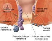 Hemorroides: tipologías, síntomas y formas de presentación