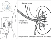 cancer-de-rinon