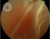 desprendimiento-de-retina