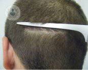 resultado-trasplante-de-pelo