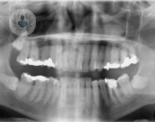 Cáncer oral: importancia del diagnóstico y tratamiento precoz.