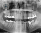 cavidad-bucal-cancer-oral