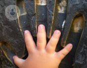 acondroplasia