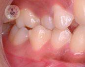 maloclusion-dental-tratamiento
