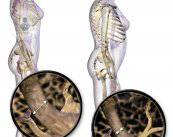La osteoporosis afecta principalmente a las mujeres