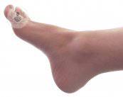 ¿Qué es la cirugía percutánea del pie?