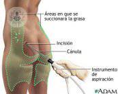 imagen-liposuccion