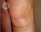 varices-pierna