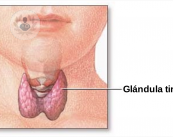 Extirpación de la glándula tiroides