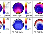 mapeo-cerebral-neurofisiologia-clinica