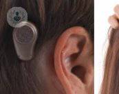 Implantes de oído y sus beneficios