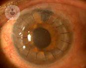 trasplante-de-cornea