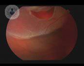 desprendimiento-de-la-retina