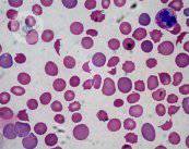 Anemia: importancia de un buen diagnóstico 