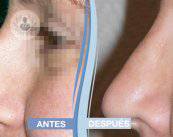 posoperatorio-rinoplastia