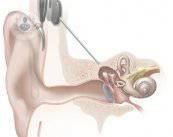 implantes-cocleares-sordera