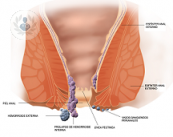 distintos-tratamientos-hemorroides