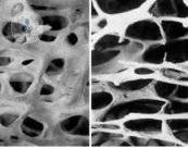 comparacion-osteoporosis