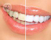 blanquear-dientes