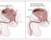 Síntomas de la Hipertrofia Benigna de Próstata para un diagnóstico precoz