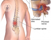 ¿Sabes por qué se produce la hernia discal lumbar?