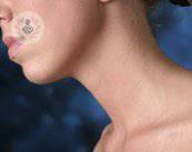 laringe-cancer-respuestas