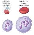 anemia-megaloblastica