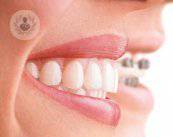 invisalign-dientes-perfectos