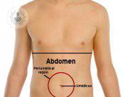 eventracion-zona-umbilical