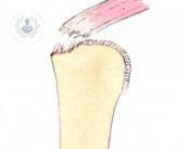 Rotura del manguito rotador o del tendón del supraespinoso