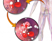 nefropatia-diabetica