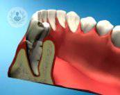 implantes-dentales-de-carga-inmediata