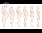 obesidad-tratamiento-quirurgico